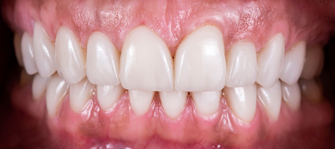 Crowns & Veneers