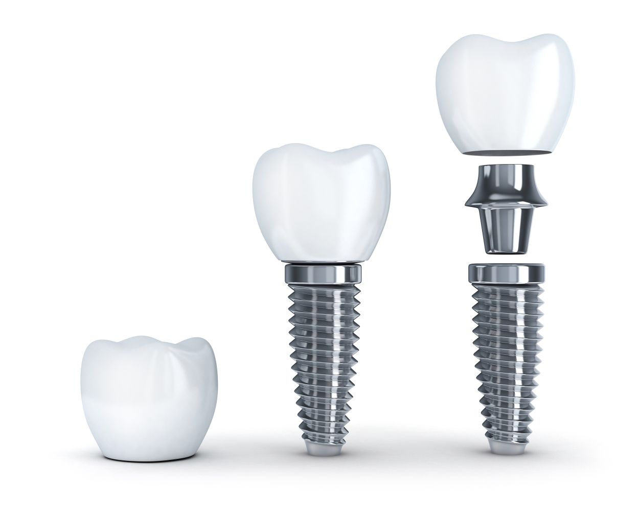 Illustration of a dental implant showing the titanium post, abutment and crown