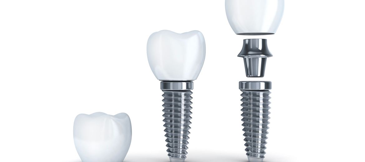 Dental Implants