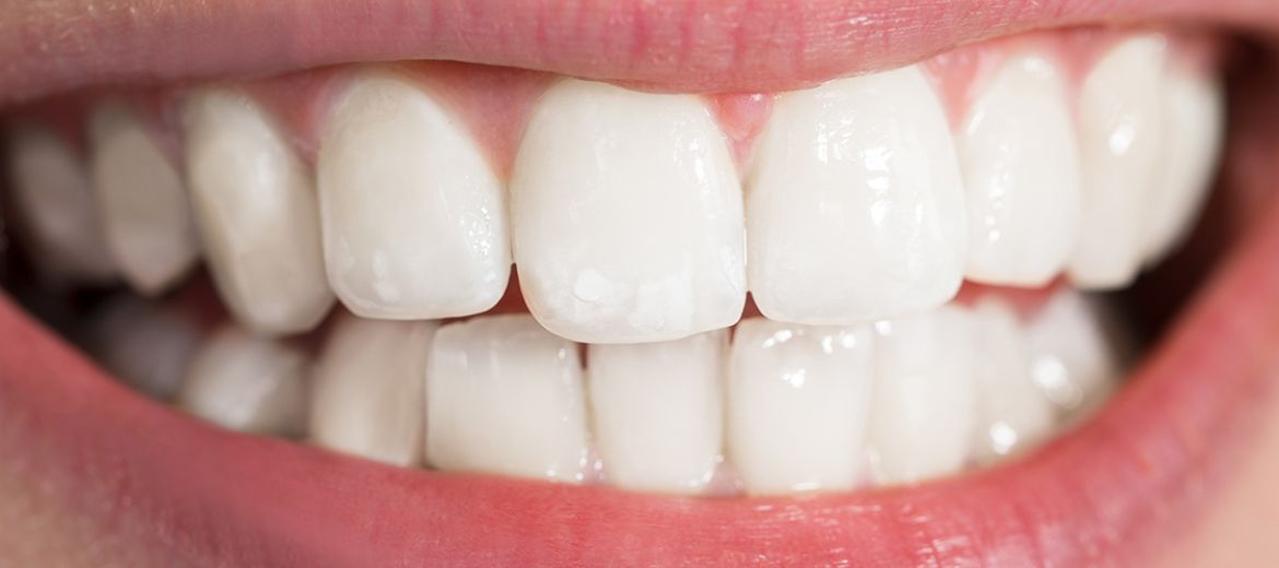 Teeth Whitening