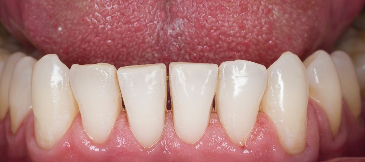 Dental Hygiene
